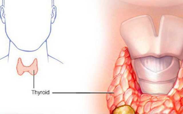 Nổi hạch to ở cổ - Dấu hiệu cảnh báo ung thư tuyến giáp