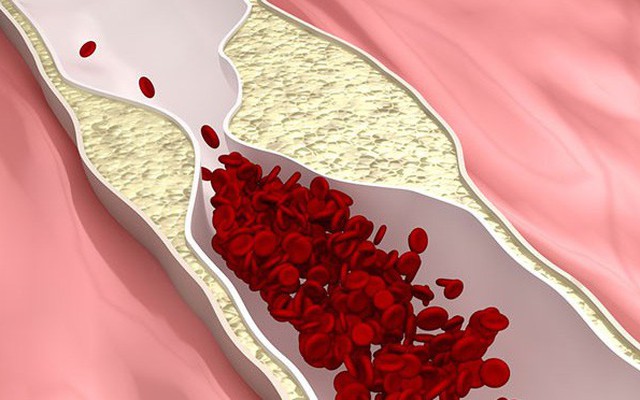 Chuyên gia chia sẻ cách làm sạch "rác" trong mạch máu: Việc làm nhỏ giúp ngăn ngừa tử vong