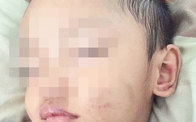 Những hình ảnh đau lòng của bé trai 3 tuổi nghi bị cha dượng bạo hành