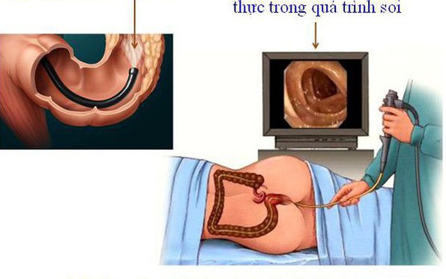 Viêm loét đại tràng có thể tăng nguy cơ ung thư đại trực tràng?