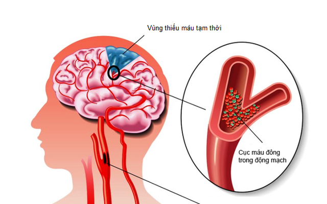 Hẹp van tim - “Thủ phạm” gây biến chứng chết người ít ai biết