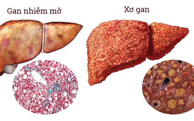 170 triệu người mắc căn bệnh nguy hiểm, dễ lây nhiễm gấp 10 lần HIV: Phòng ngừa thế nào?