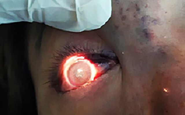 Nâng mũi làm đẹp, người phụ nữ ở Sài Gòn bị hỏng mắt trái