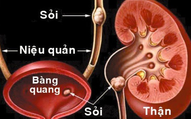 Hi hữu bé gái 9 tuổi viêm sỏi thận to bằng viên bi