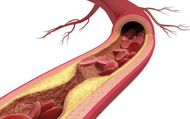 Nhóm thuốc statin làm giảm nguy cơ tử vong do các bệnh lý tim mạch ở nam giới