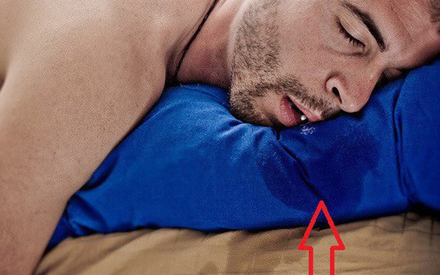 Chảy nước dãi khi ngủ: Đừng chủ quan với dấu hiệu cảnh báo 3 căn bệnh nguy hiểm