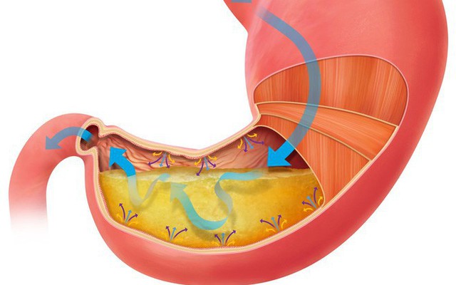 3 loại nước sẽ khiến bệnh dạ dày trở nên trầm trọng: Có thể bạn đang uống mà không biết!