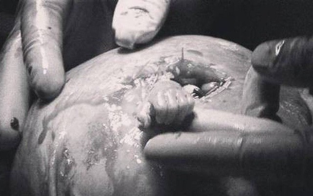 Đang hoàn tất ca sinh mổ thai ba, bác sĩ giật mình phát hiện còn một cánh tay nữa trong bụng mẹ
