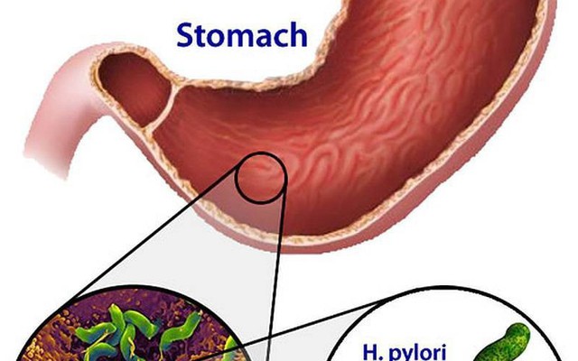 Chọn kháng sinh diệt vi khuẩn H.Pylori hiệu quả