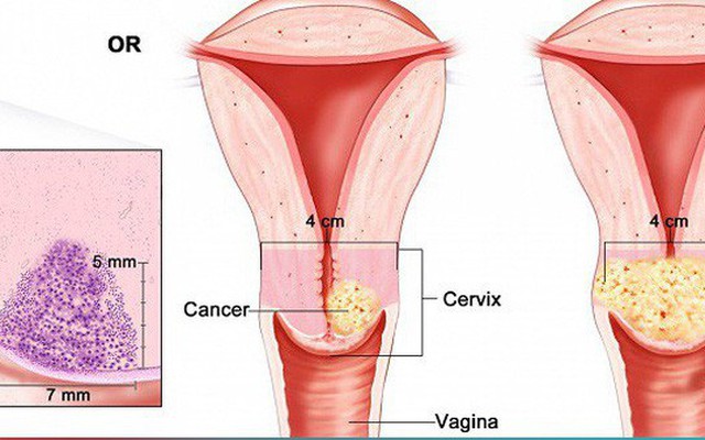 5 loại ung thư thường gặp ở nữ giới
