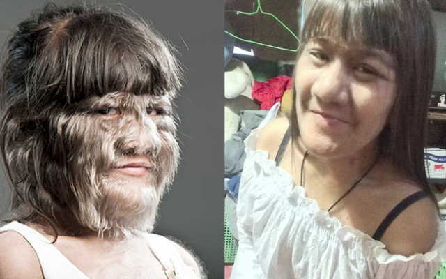 Thái Lan: Cô gái 17 tuổi giữ kỷ lục nhiều lông nhất thế giới khiến mọi người kinh ngạc khi cạo sạch lông mặt!