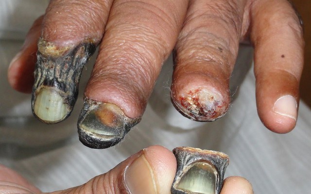 Ma túy "thây ma" Krokodil khiến cơ thể bị thối rữa đã xuất hiện ở Anh