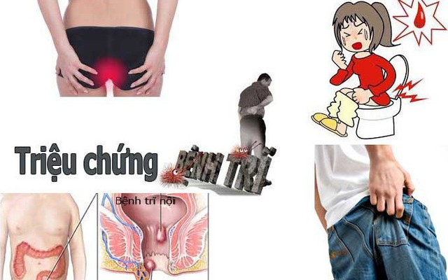 Bệnh trĩ – Không sớm điều trị, hậu quả khó lường