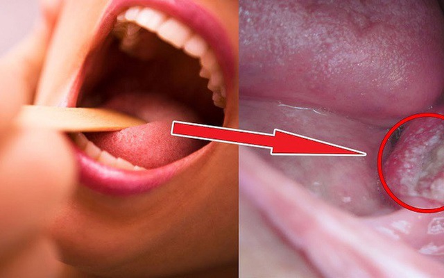 Căn bệnh ung thư vòm họng đe doạ người Việt: 3 dấu hiệu điển hình nhận biết ung thư sớm