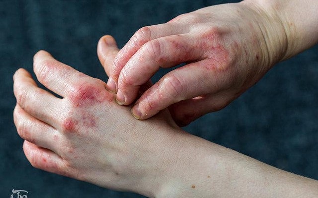 Bệnh eczema là gì? Nguyên nhân, triệu chứng và cách chữa hiệu quả