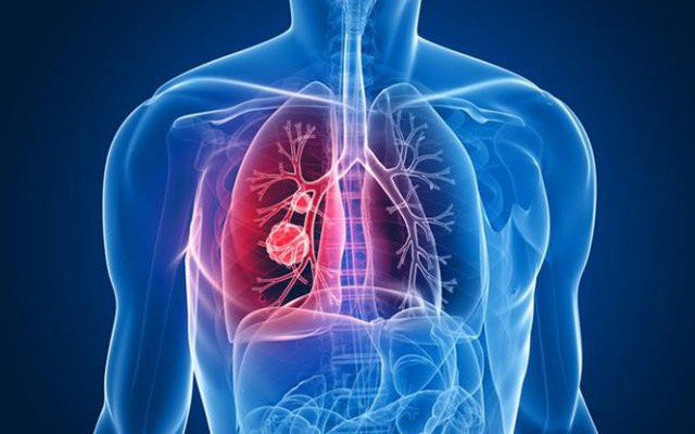 Đau lưng có phải là triệu chứng sớm của ung thư phổi: Bác sĩ chỉ cách nhận biết quan trọng