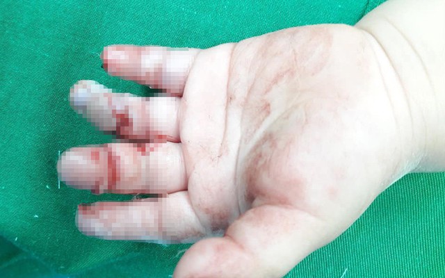 Bé 16 tháng bị dập 3 ngón tay vì thò vào máy xay thịt của gia đình