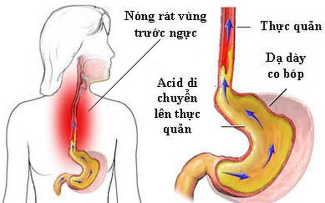 Trào ngược thực quản có thể biến chứng thành ung thư: GS tiêu hoá mách cách "sống chung"