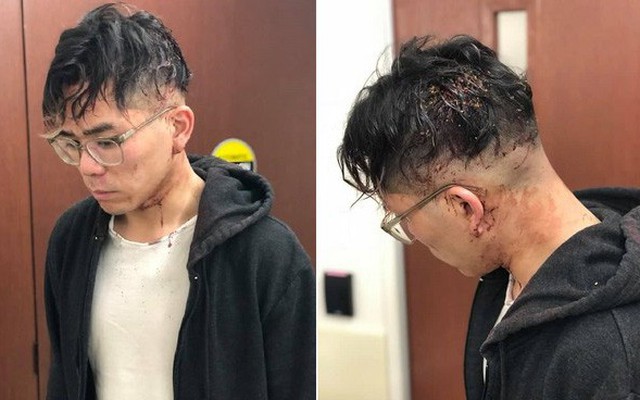 Nam thanh niên tố bị chủ nhà hàng người Việt tại Mỹ đánh đập dã man vì xin nghỉ làm