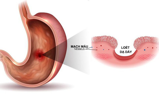 7 triệu chứng không đau có thể là dấu hiệu sớm của ung thư: Khám sớm có thể cứu sống bạn