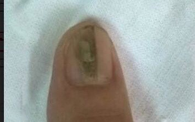 Kẻ sọc trên ngón tay: Dấu hiệu căn bệnh khiến người mắc ngại không dám... lấy chồng