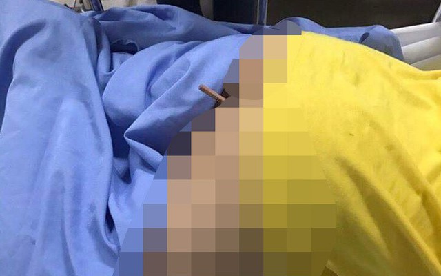 Nam sinh lớp 4 nhập viện vì bị bút chì dài gần 20cm đâm sâu vào mông