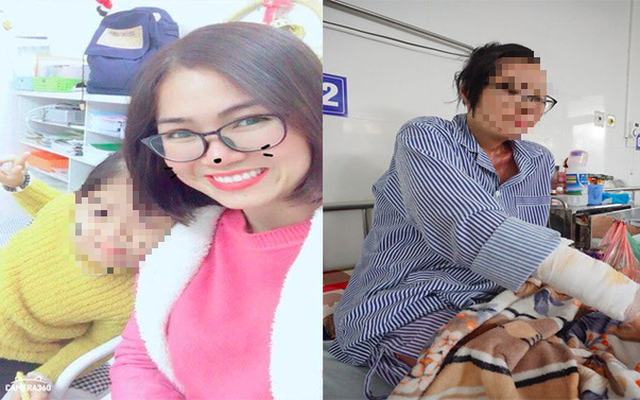 1 năm sau khi bị chồng cũ tạt axit, cô giáo Hà Nội xinh đẹp kể về 5 ngày chết lâm sàng, 21 lần ghép da