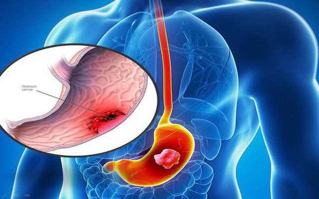 Cháu bé 12 tuổi đã mắc ung thư: BS cảnh báo căn bệnh ung thư khó phát hiện đang trẻ hoá