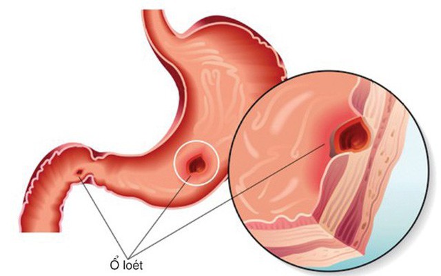 BS cảnh báo: Người trẻ mắc bệnh dạ dày ngày càng nhiều là do đã "cố ý" làm sai 2 điều