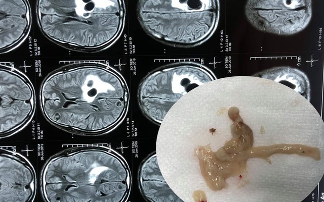 Đau đầu đi cấp cứu phát hiện 5 ổ sán lớn nằm trong não người đàn ông ăn tiết canh