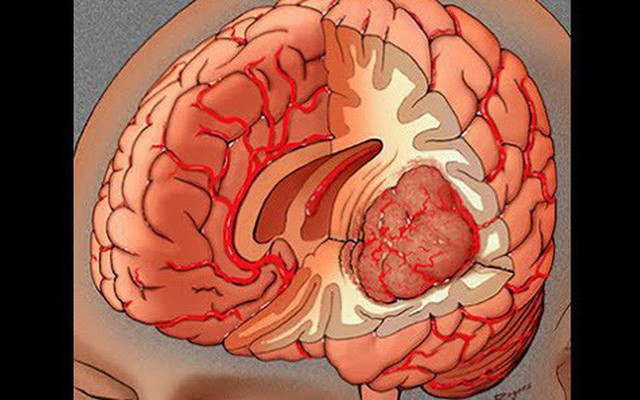 Bác sĩ BV 108: 8 dấu hiệu có thể bạn bị u não, nếu có cần đến viện kiểm tra ngay