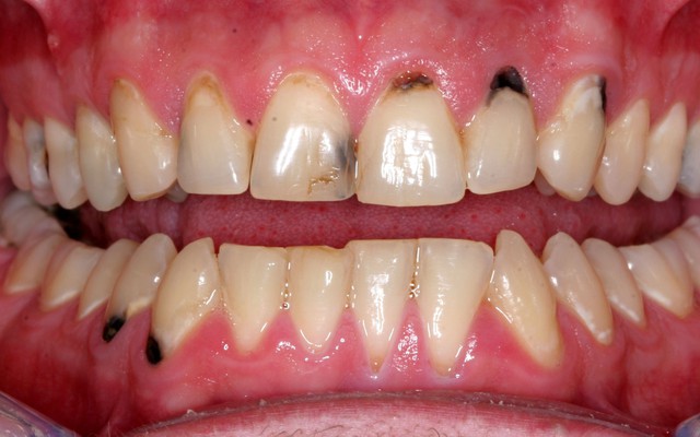 Chân răng bị đen có nguy hiểm không: Giải pháp làm trắng và ngăn ngừa răng xỉn màu