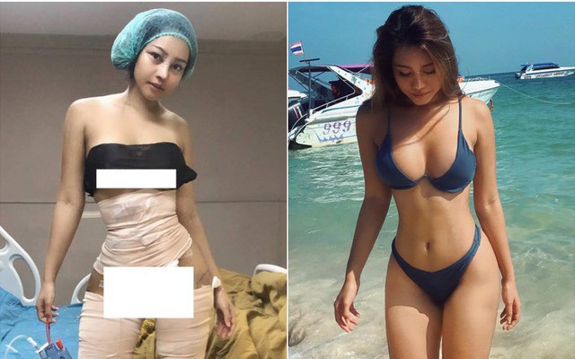 Hot girl bốc lửa Thái Lan bất ngờ công khai ảnh phẫu thuật để có eo con kiến, điều đáng nói đây không phải lần đầu cô lột xác
