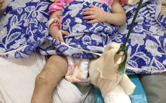 "Mẹ nuôi" đánh bé gái 1 tuổi đến gãy chân chỉ vì biếng ăn, hay khóc