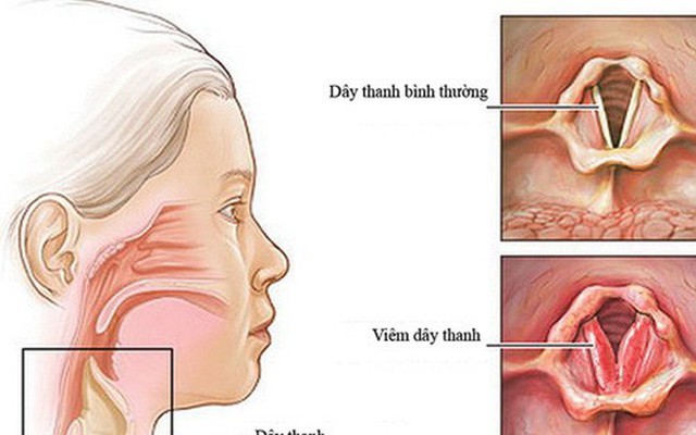 Cách giữ giọng không khàn