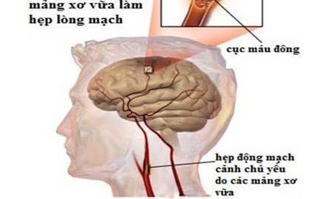 Bệnh mạch máu não: Phòng ngừa từ các yếu tố nguy cơ