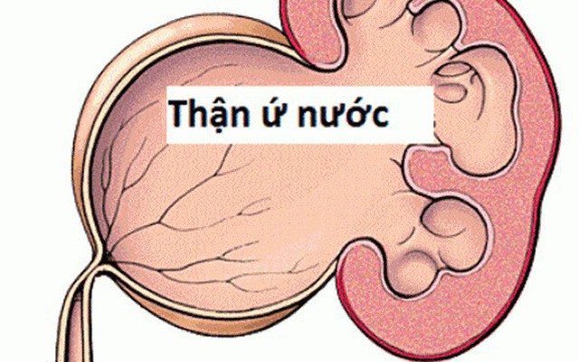 Bài thuốc trị thận ứ nước