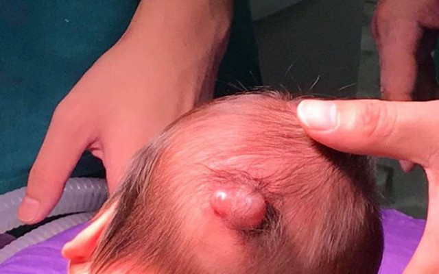 Bé trai vừa sinh ra đã có khối u sau đầu