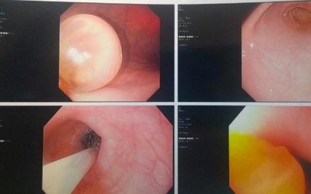 Con trai ăn gì nôn nấy, mẹ đưa đi khám thì choáng váng khi biết có thứ đồ chơi trẻ em này nằm trong ruột con