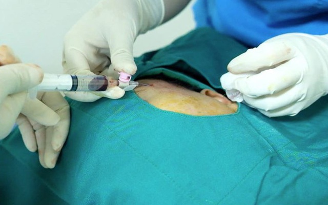 Độn thái dương làm đẹp nam thanh niên suýt nguy kịch