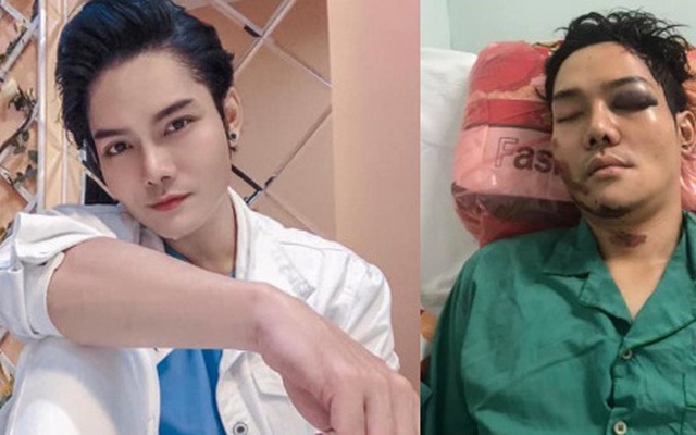 Sau tai nạn nghiêm trọng, con trai nuôi nghệ sĩ Hoài Linh phẫu thuật nối xương hàm bị gãy đôi vào sáng nay