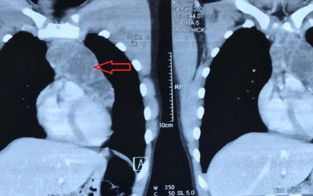 Chỉ ho nhói nhẹ, vào viện thấy u ngực to đến ngỡ ngàng