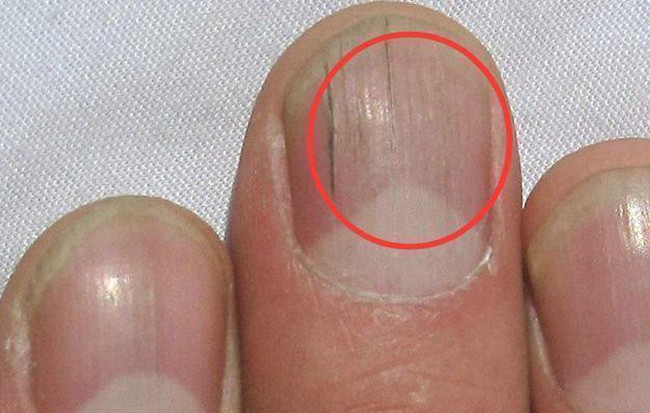 Nếu gan sinh bệnh hoặc nhiễm độc, móng tay sẽ có 3 thay đổi bất thường dễ nhận biết