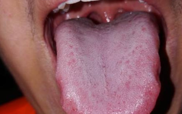 Bị Sùi Mào Gà Dọc Cuống Lưỡi, Bệnh Nhân Vẫn Cãi Bác Sĩ 'Sùi Mào Gà Sao Mọc  Được Ở Trong Mồm'