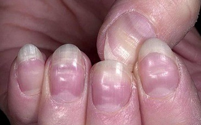 Nh&igrave;n m&oacute;ng tay đo&aacute;n bệnh