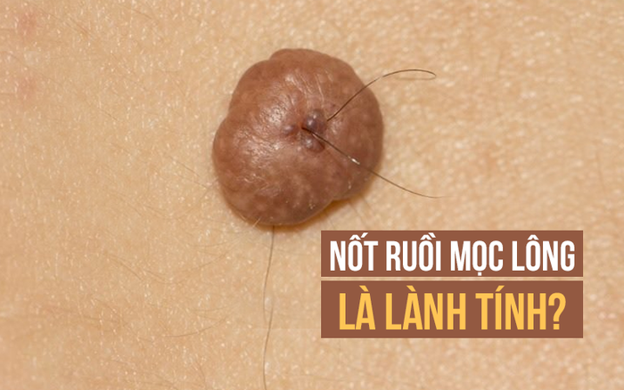 NỐT RUỒI MỌC LÔNG Ở VÙNG CỔ THỂ HIỆN TÀI LỘC VÀ ĐỊA VỊ TRONG XÃ HỘI