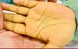 5 dấu hiệu nhận biết sớm ung thư gan không nên bỏ qua
