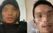 Chàng trai 27 tuổi mắc ung thư trực tràng giai đoạn cuối vì ăn món nhiều người mê này mỗi tối